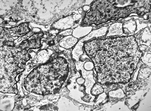 F,12y. | malignant tumor of the orbita - liposarcoma?, neurofibrosarcoma? F,12y. | malignant tumor of the orbita - liposarcoma?, neurofibrosarcoma?